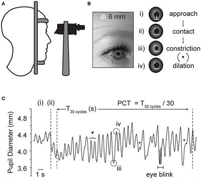 Pupil Cycle Time Distinguishes Migraineurs From Subjects Without Headache